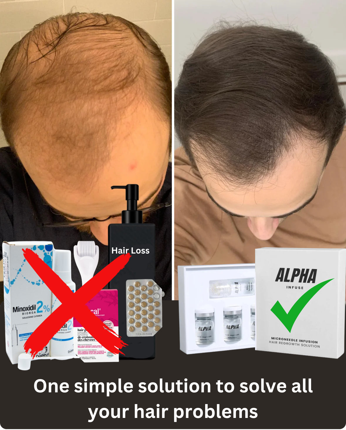 Before-and-after comparison of hair regrowth treatment with Alphavance product featured.