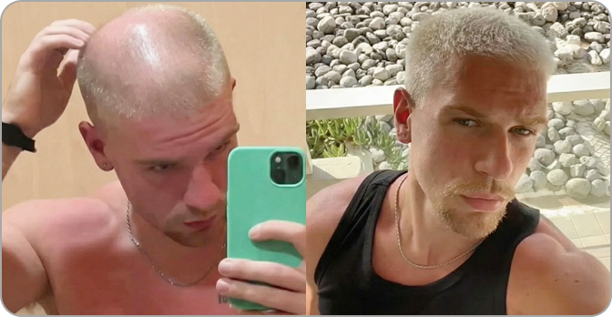 AlphaVance customer hairline result