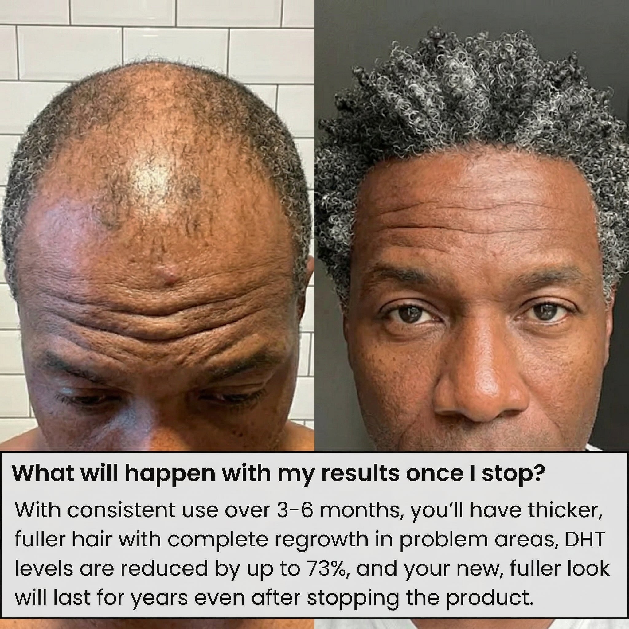 AlphaVance™ Hair Regrowth System